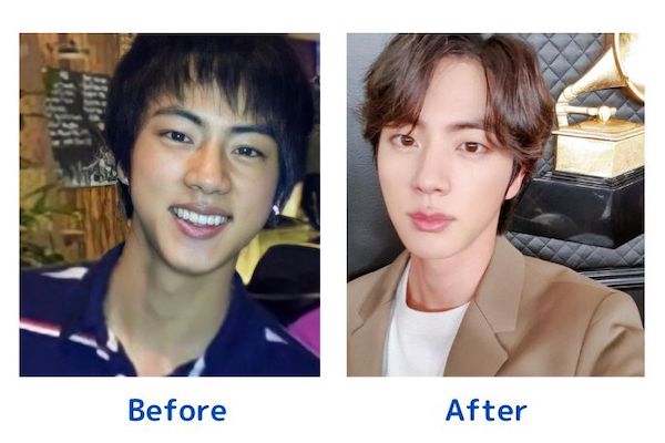 BTSJIN整形